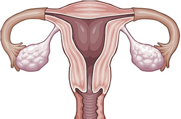 Qué pasaría si a una mujer le extirpan los ovarios